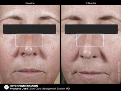 pichyperpigmentation2