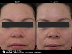 pichyperpigmentation5