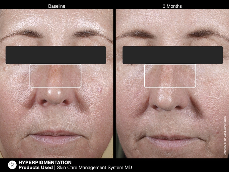 pichyperpigmentation2