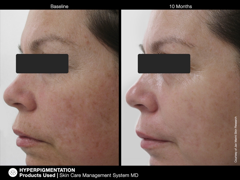 pichyperpigmentation6