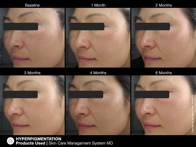 pichyperpigmentation7