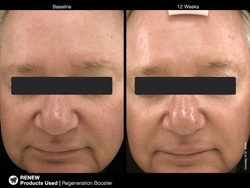 picregenerationbooster3