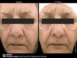 picregenrationbooster4